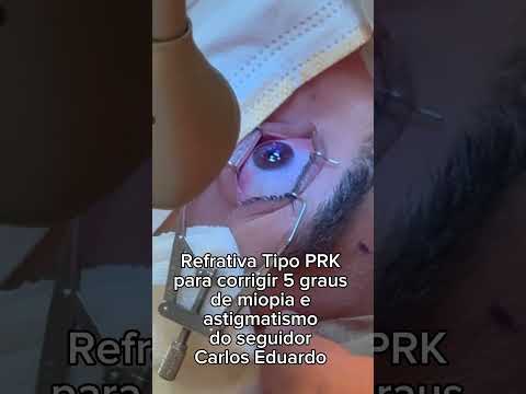 Cirurgia Refrativa Tipo PRK para eliminar óculos. 5 graus de miopia e astigmatismo.