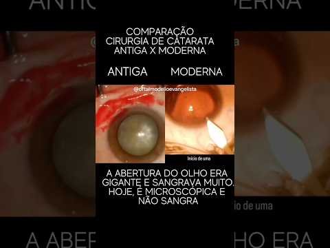 Cirurgia de catarata antiga x moderna