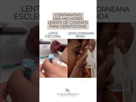 Comparativo das melhores lentes de contato para ceratocone
