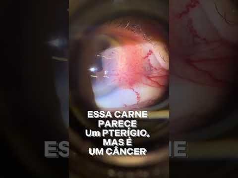 Essa”carne no olho” no caso dela infelizmente é um câncer