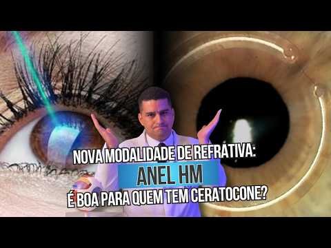 Nova modalidade de cirurgia refrativa: ANEL HM é boa para quem tem ceratocone?