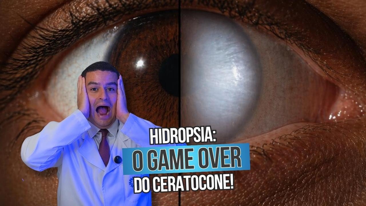 Hidrópsia no ceratocone: quando a córnea entra em emergência