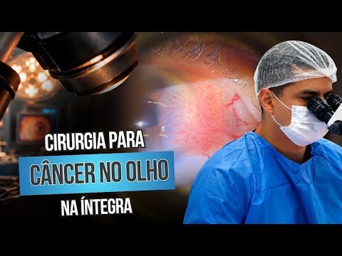 Remoção de câncer no olho-carcinoma espinhocelular de conjuntiva (CEC)