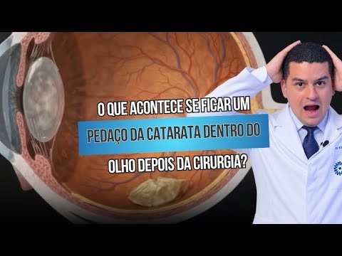 O que acontece se ficar um pedaço da catarata dentro do olho depois da cirurgia?